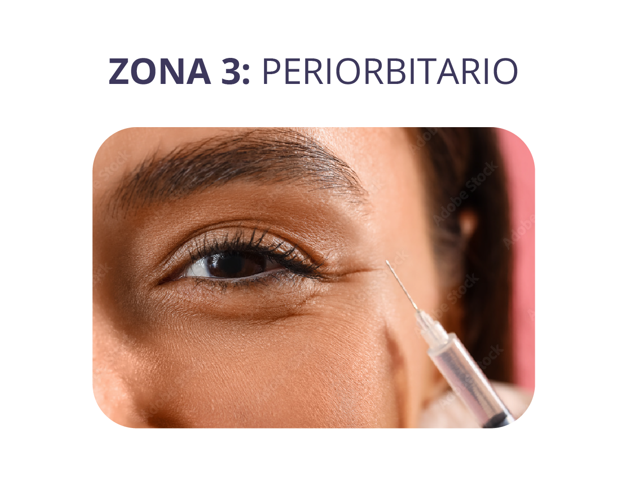 zonas landing relleno_periorbitario.png