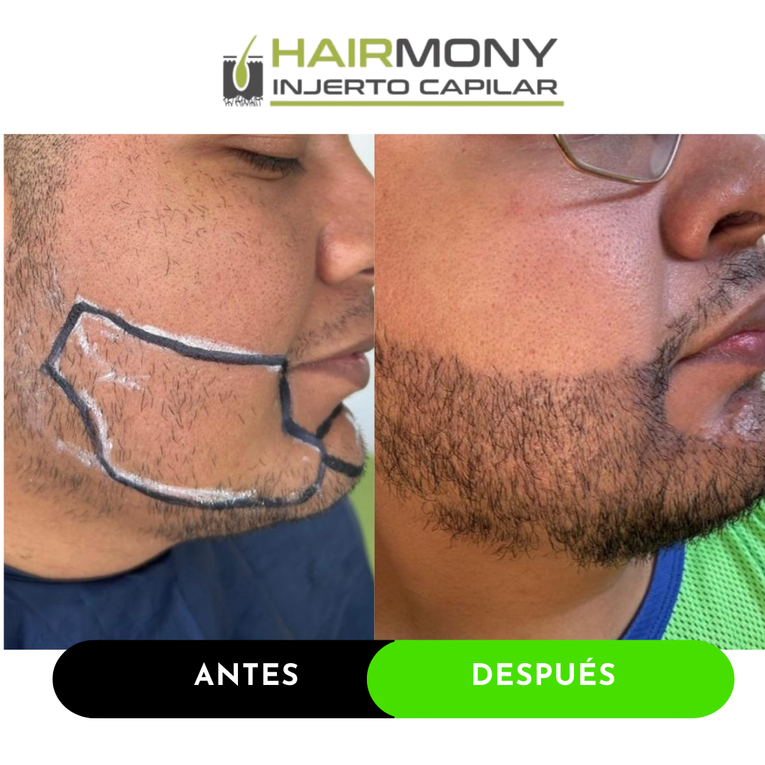 Copia de TRASPLANTE CEJAS AYD (2).png