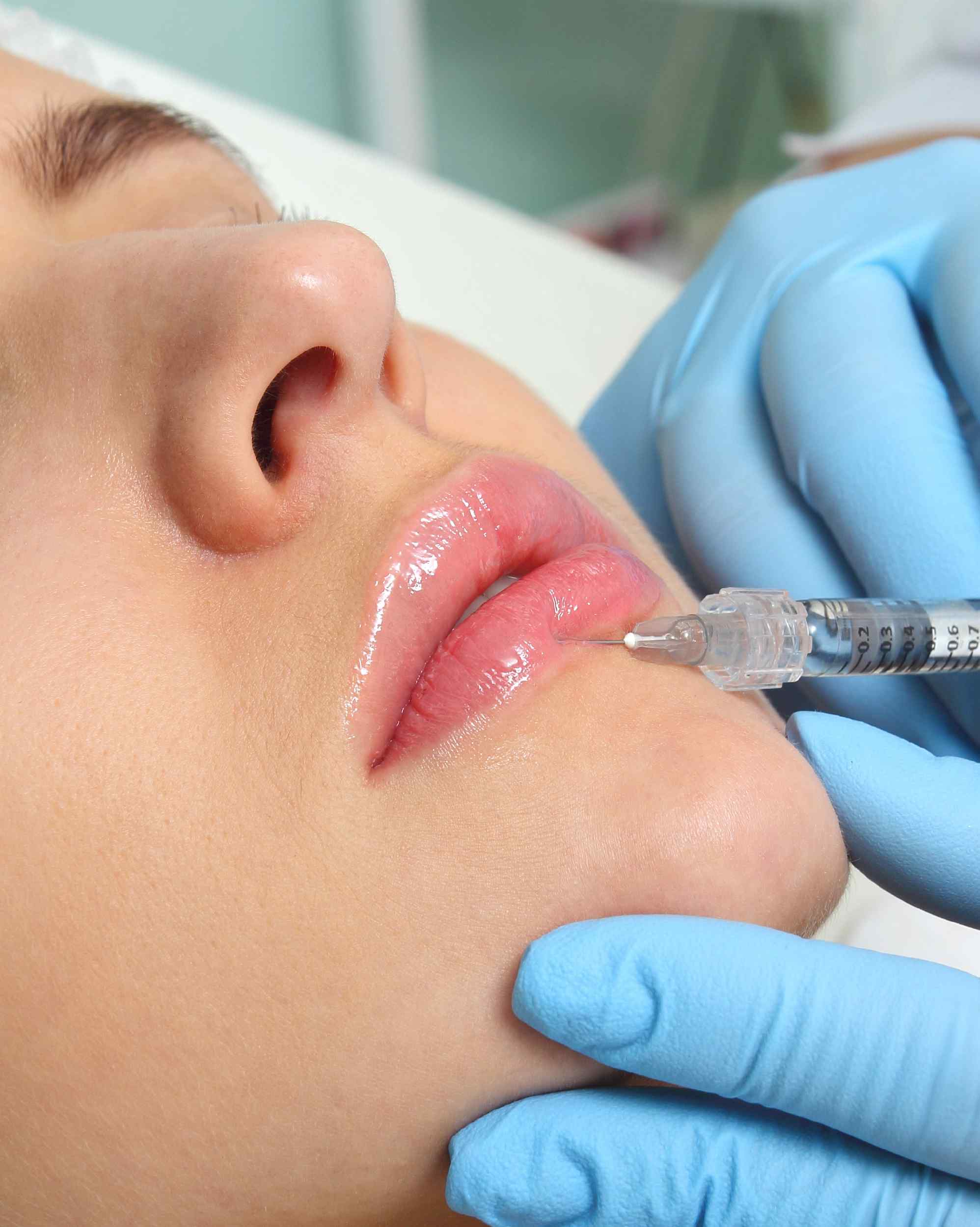 Landing relleno y botox_relleno facial-12.jpg