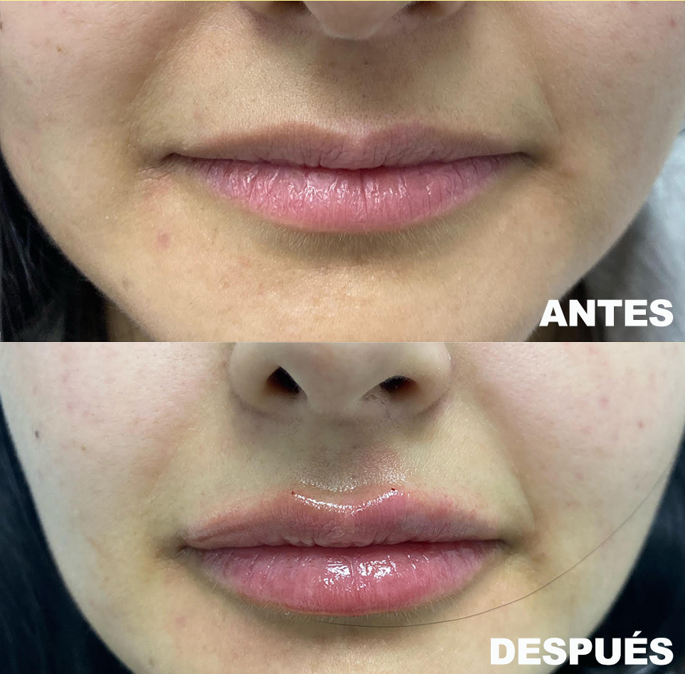 aumento_labios.jpg