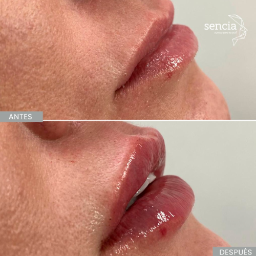 Perfilamiento de labios.png