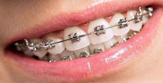 brackets-metalicos.jpg