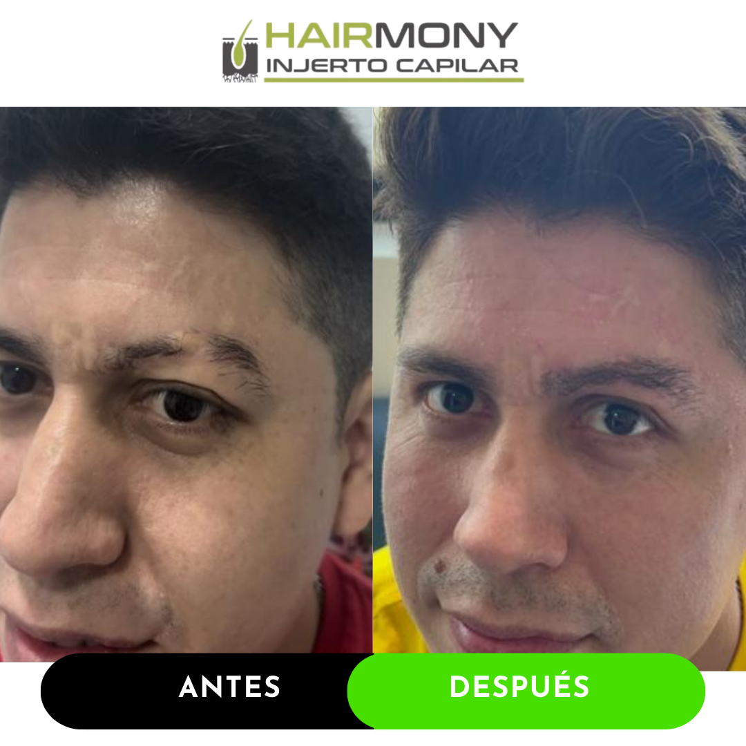 Copia de TRASPLANTE CEJAS AYD.png
