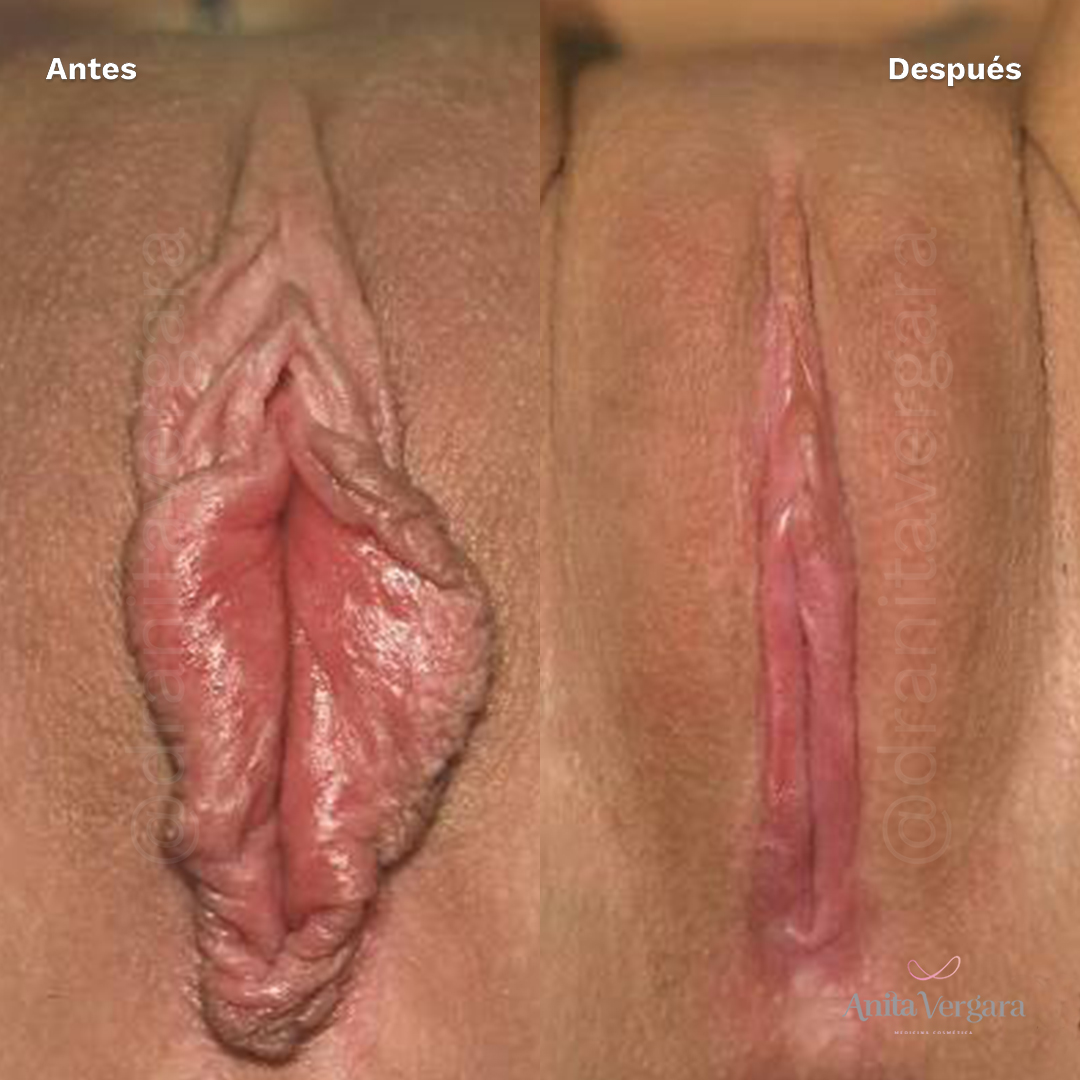 ayd labioplastia 2.jpg